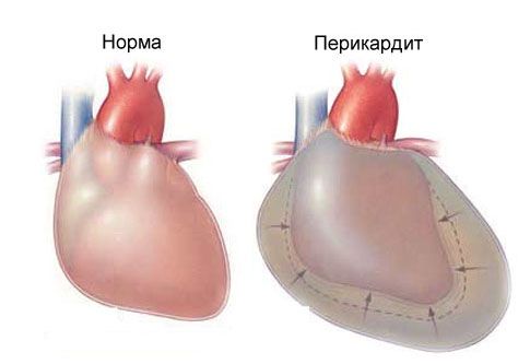 Ostre zapalenie osierdzia i bóle w klatce piersiowej po lewej stronie