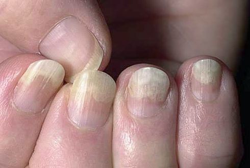 Obieranie płytki paznokcia z tkanek miękkich