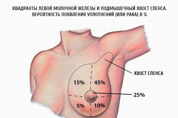Ćwiartki lewej piersi i pachowy spence.  Prawdopodobieństwo plomb (lub raka) w%