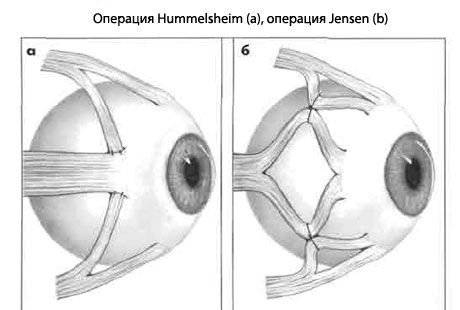 Strabismus - Operacja