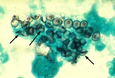 Czynnik sprawczy pneumocystis (Pneumocystis jiroveci)