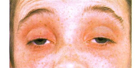 Oftalmoplegia zewnętrzna.  Dwustronne opadanie powiek.  Pacjent otwiera oczy, unosząc brwi