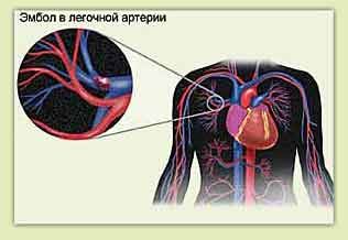 Zator tętnicy płucnej i bóle w klatce piersiowej po lewej stronie