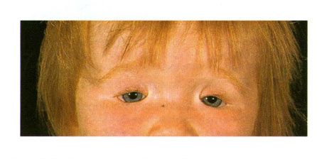 Dwustronna coloboma powiek u dziecka z zespołem Goldena.  Zamknięcie szczeliny oka po lewej stronie